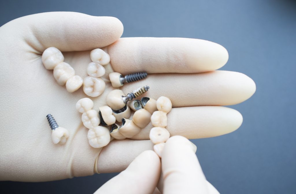 How to Choose the Best Dental Implant Dentist for Your Needs