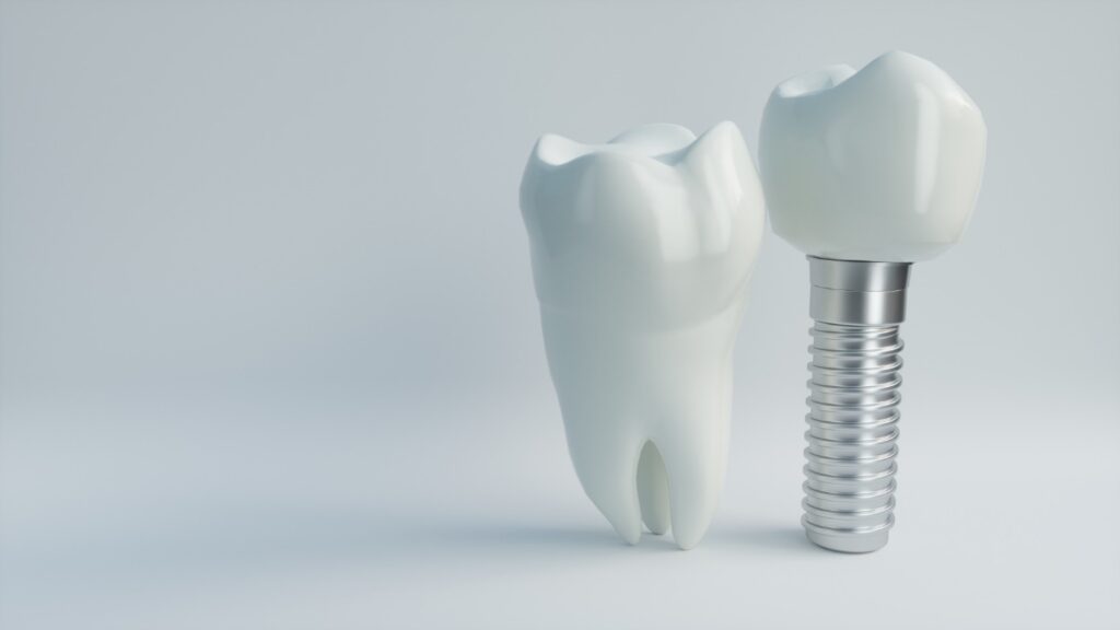 Everything to Know About Implant Crowns