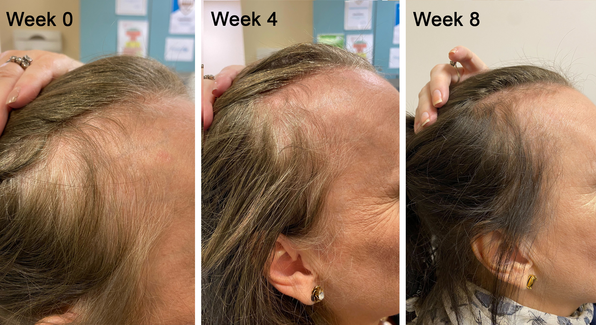 Understanding How PRP Therapy Can Help Restore Hair Loss