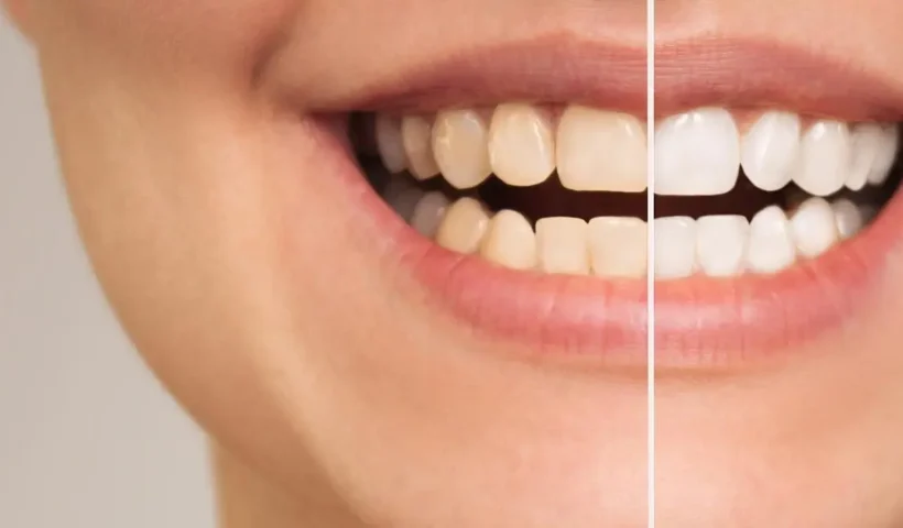 Why People With Sensitive Teeth Make Whitening Problems Significantly Worse