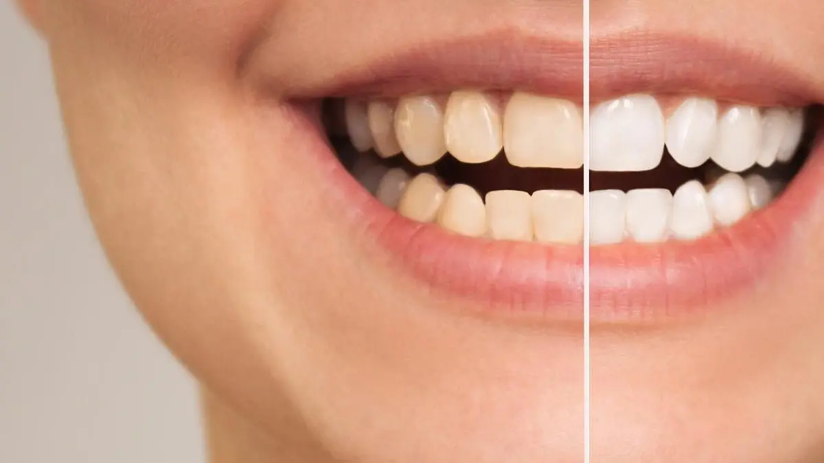 Why People With Sensitive Teeth Make Whitening Problems Significantly Worse